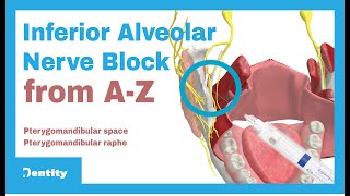 Inferior Alveolar Nerve Block | A-Z