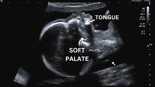 Ultrasound Pregnancy Palate (hard and soft palate) for cleft palate and cleft lips assessment. screenshot 5