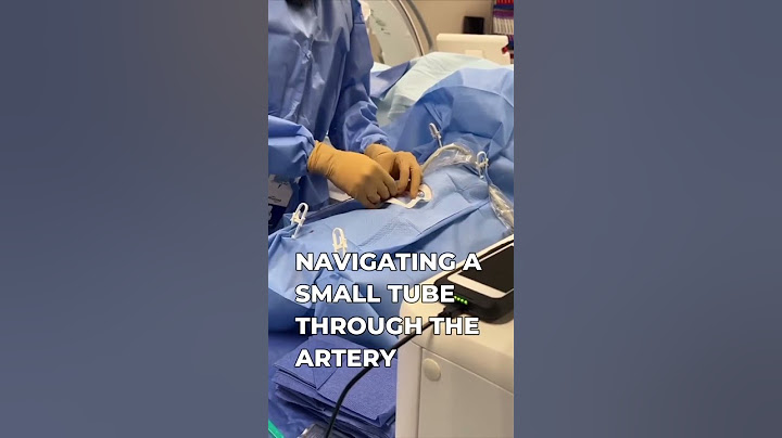 Minimally invasive procedure that helps shrink fibroids #fibroids #ufe #uterinefibroidembolization