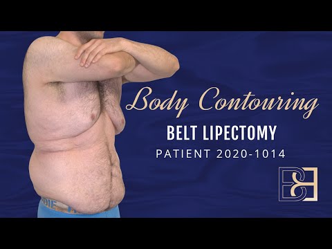 Belt Lipectomy Surgery Without Liposuction