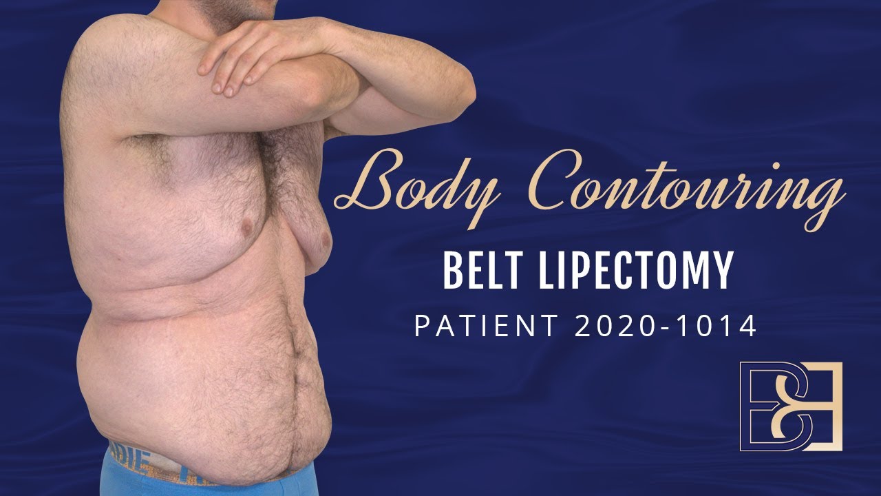 Operation Guide: Belt Lipectomy Surgery Without Liposuction