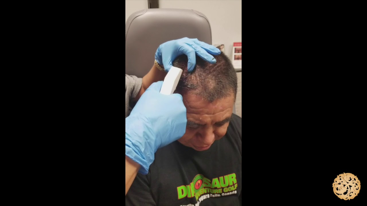 Taking Out Staples In Head at Claire Roessler blog