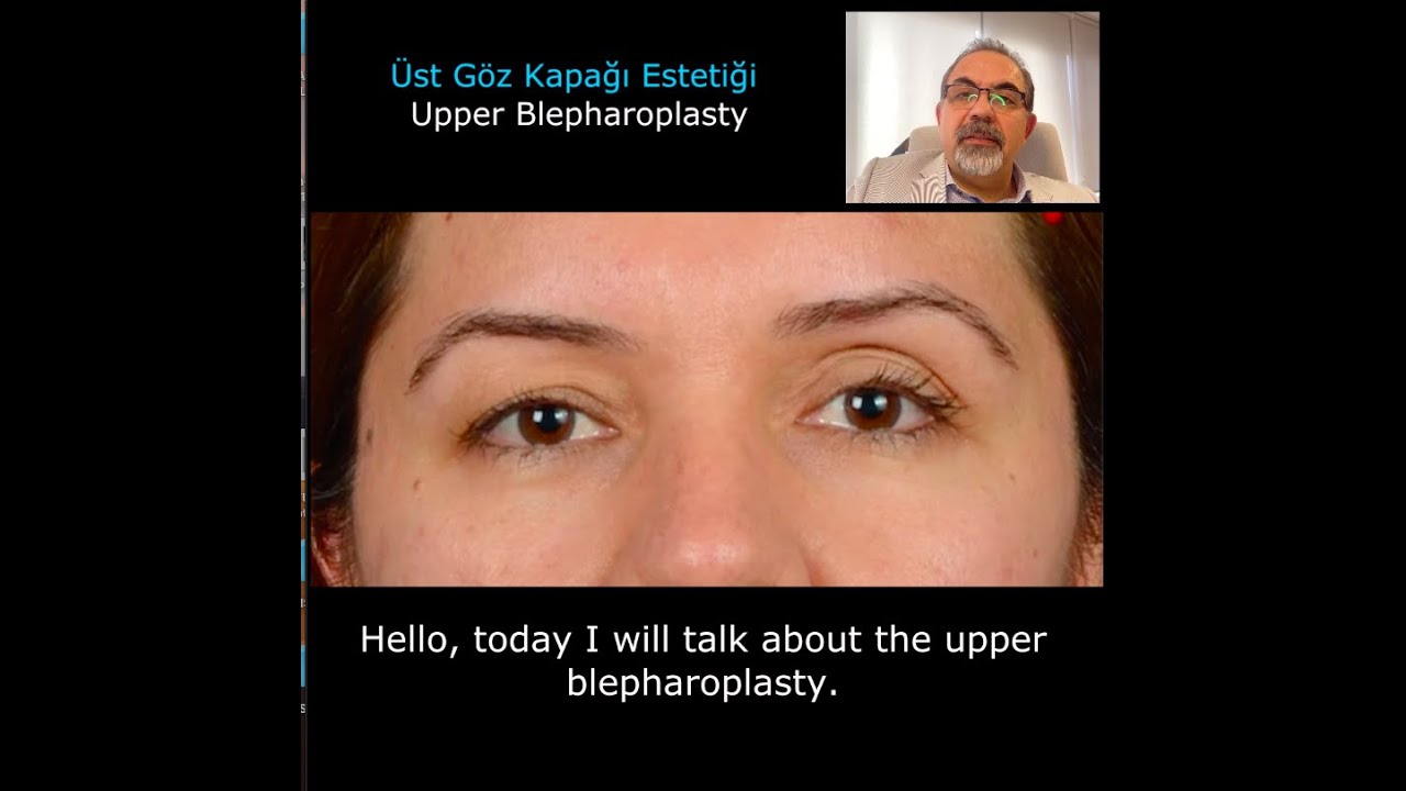 Üst Göz Kapağı Estetiği (Blepharoplasty - Blefaroplasti) Adana