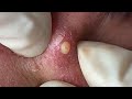 Huong Da Nang Acne Treatment #280