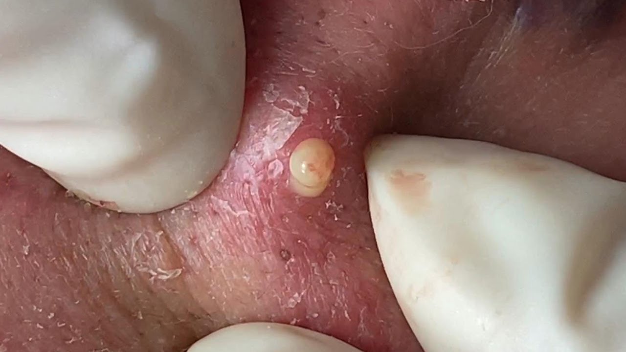 Huong Da Nang Acne Treatment #280 - YouTube