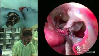 Endoscopic Medial Maxillectomy & Inferior Turbinate Reduction Demo by Rick Chandra, MD