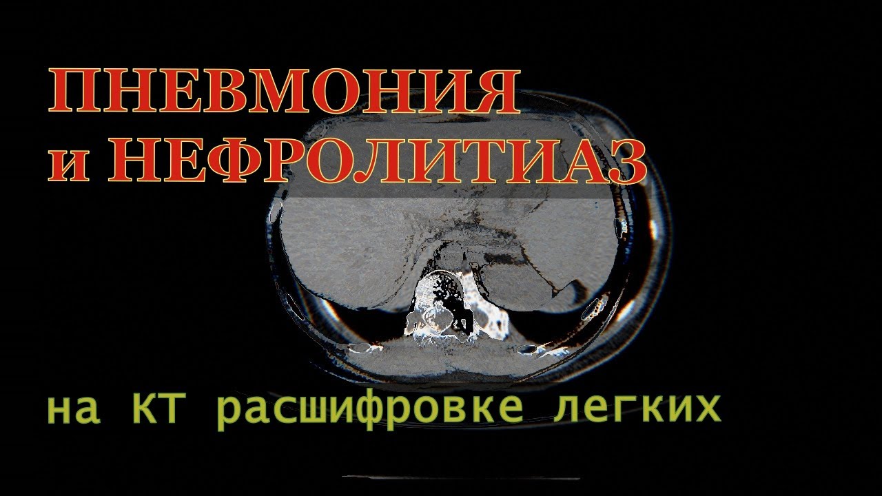 Правосторонняя верхнедолевая ПНЕВМОНИЯ и НЕФРОЛИТИАЗ ПОЧЕК на ...
