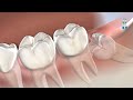 Wisdom teeth removal in springfield il at oral  facial surgeons of illinois