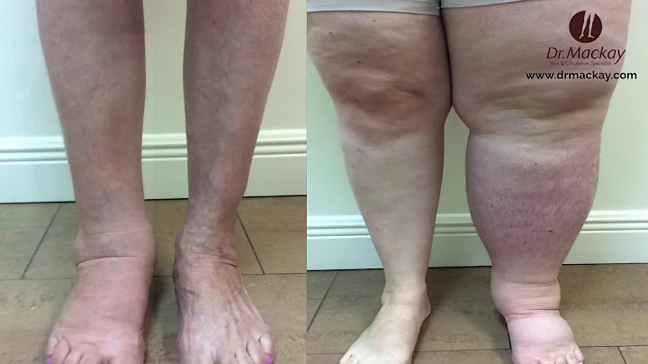 Varicose Veins in Men by Dr. Mackay, Vein Surgeon
