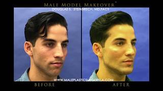 LA Male Model Makeover with Facial Filler by Dr. Steinbrech #7