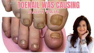 Why Thick Toenails Caused from Running Hurt More Than It Looks