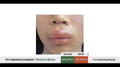 Что делать, если возникает отек Квинке