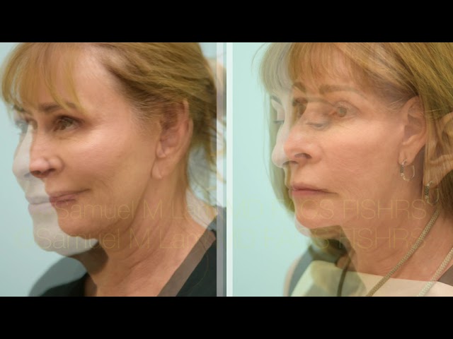 Dallas Facelift Before and After