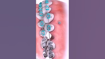 Tác dụng của minivis khi niềng răng #braces #orthodontist