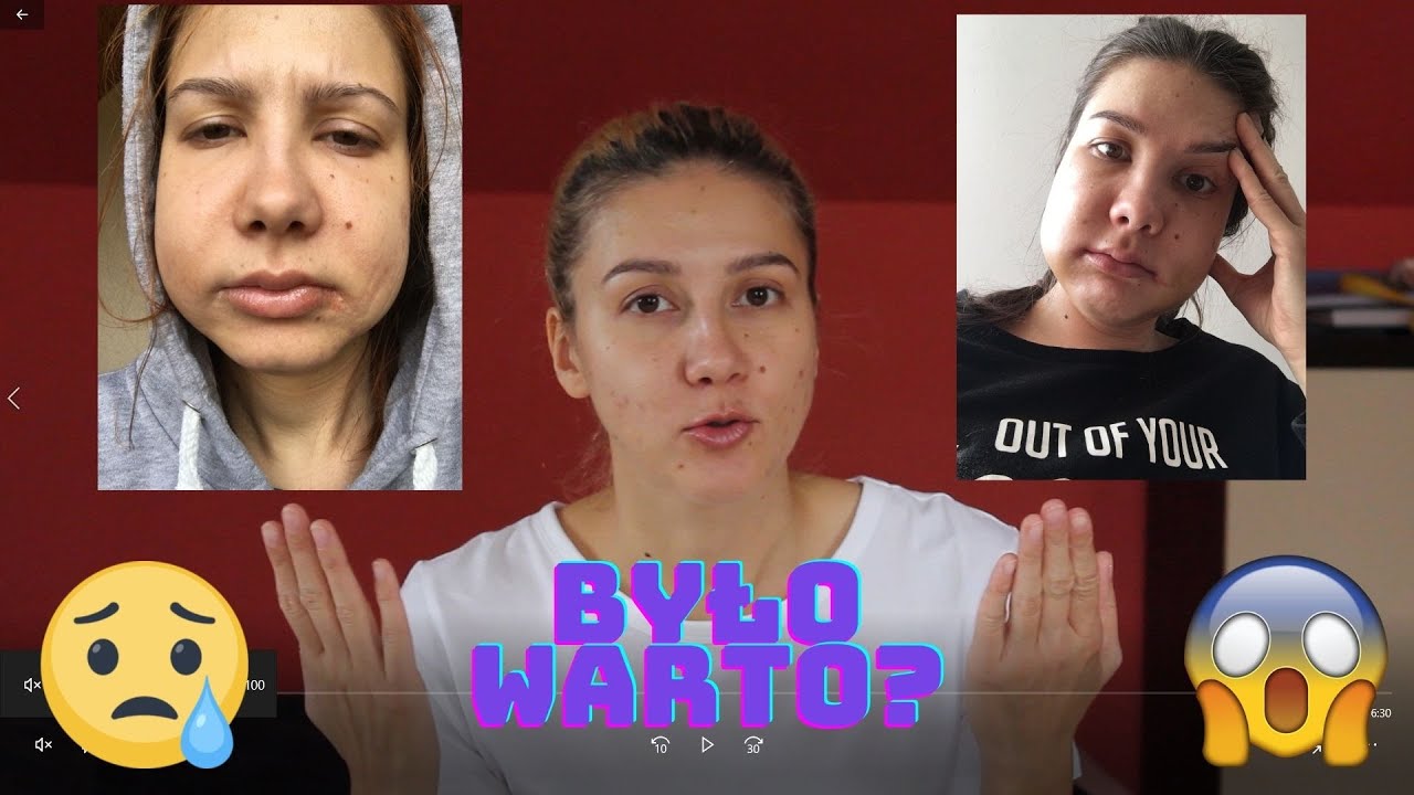 Operacja dwuszczękowa - wrażenia po roku. Czy żałuję? #32