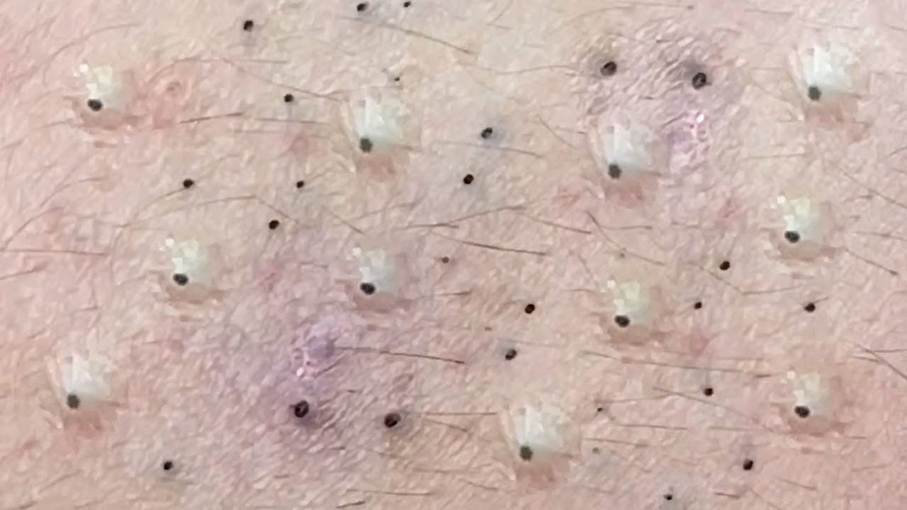Удаление стеатоцистом. Стеатоцистома множественная