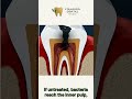 What Happens If You Ignore a Small Cavity? (Shocking Truth) #dentalcare #smiledesigndental