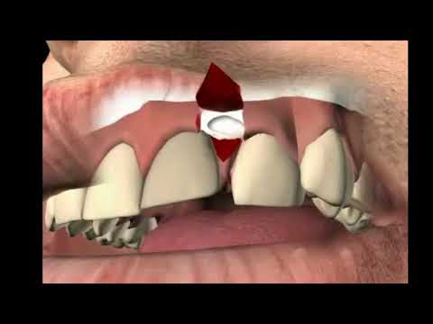 Video: Chistul Radicular: Simptome, Tratament, Intervenții Chirurgicale, Cauze