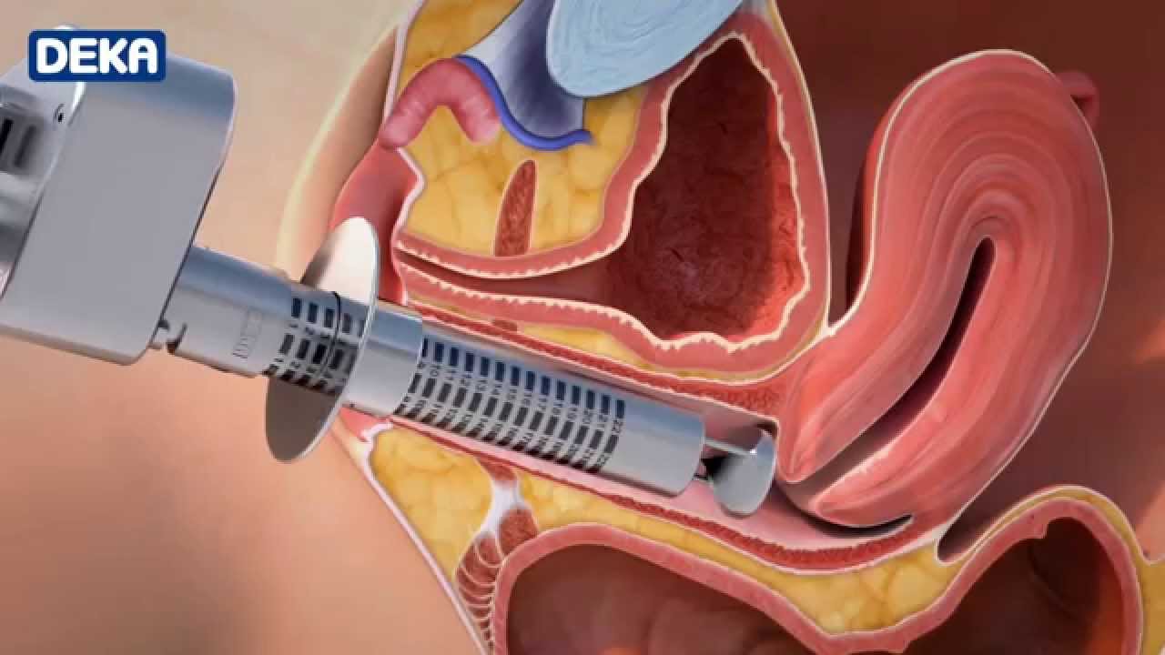 vaginal massasje eroscillator vaginal massasje eroscillator