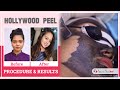 Hollywood Facial (Carbon Peel) | Glowing Skin Treatment | Dr Jagdish Sakhiya | Sakhiya Skin Clinic