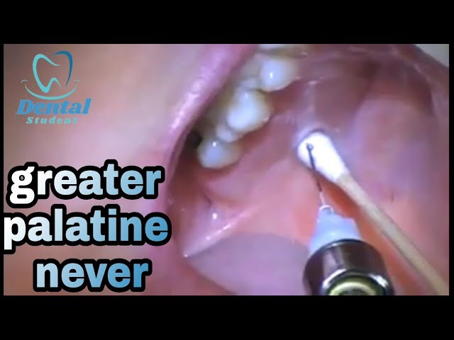 Palatal Injection Method Palatine Nerve Block Sphenopalatine Ganglion Block – Anaesthesia