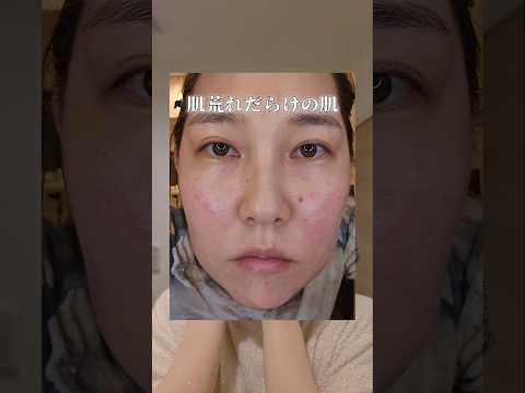 肌荒れだらけの肌が「肌綺麗だね！」と言ってもらえるようになるまでの道のりは、険しかったです。でも、自分と向き合うことを諦めないでいたら少しずつでも変われた✨#赤ら顔 #肌荒れ #薄肌 #敏感肌
