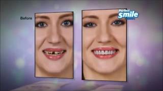 Perfect Smile Veneers - As Seen On TV