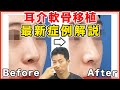 鼻尖軟骨移植（耳介軟骨移植）の動画