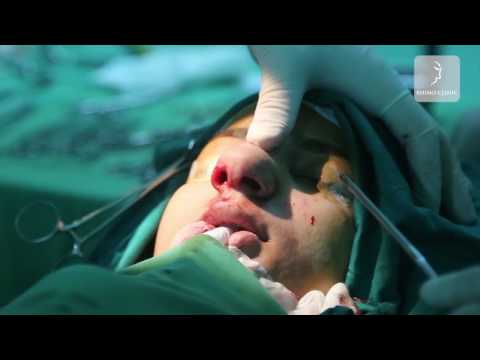 فيديو: الممثلة تعفن طرف أنفها بعد الجراحة التجميلية
