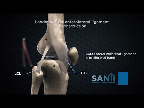 Anterolateral extra-articular procedures combined with ACL reconstruction