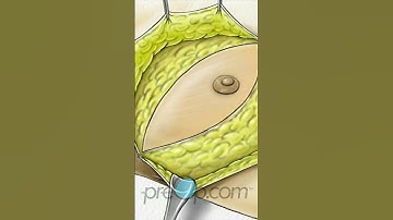 🩺 Total Mastectomy Explained! #shorts #preop #CancerAwareness 🎗️