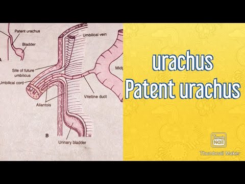 Video: Urachus Cyst - Symptoms, Diagnosis, Treatment