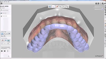 3Shape Dental System 2014: Splint Designer