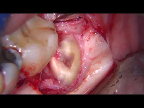 Third molar extraction with microscope and nerve exposure