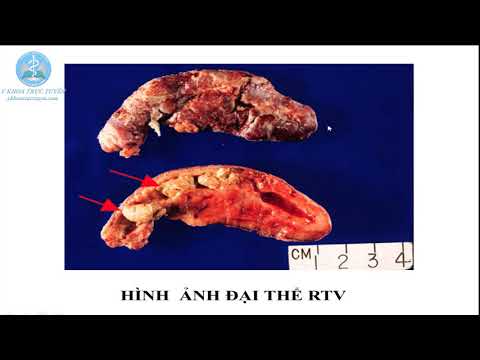 Video Ruột thừa viêm cấp - Thực hành giải phẩu bệnh - YouTube