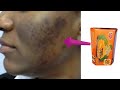 Ways to identify original Asantee papaya soap for pimples and dark spots on face - Asantee soap