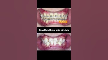 Cận cảnh quá trình thay đổi răng khấp khểnh, khớp cắn chéo mức độ 2