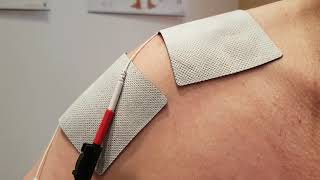 Axillarisparese M Deltoideus Einzelzuckungen Mit Den120