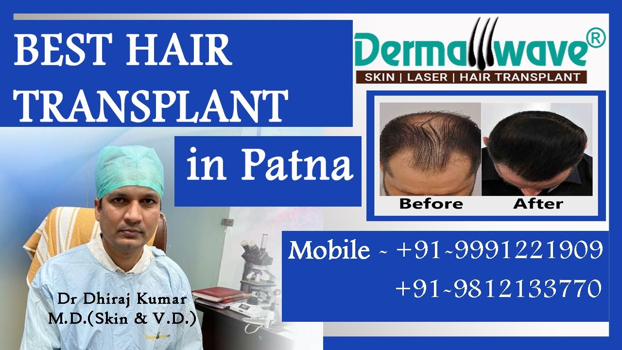 Hair Transplant in Patna  Best Results  Cost of Hair Transplant in Patna   YouTube
