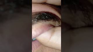 ASMR sound's message therapy #ingrownhairremoval #satisfying #thebarbersarms #removeingrown