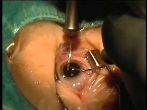 Operacija katarakte, sive mrene