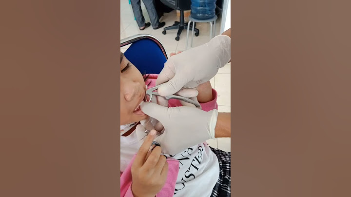 cabut gigi anak, gigi sudah goyang dan gigi penganti sudah tumbuh... hebat anak mama nangis sedikit