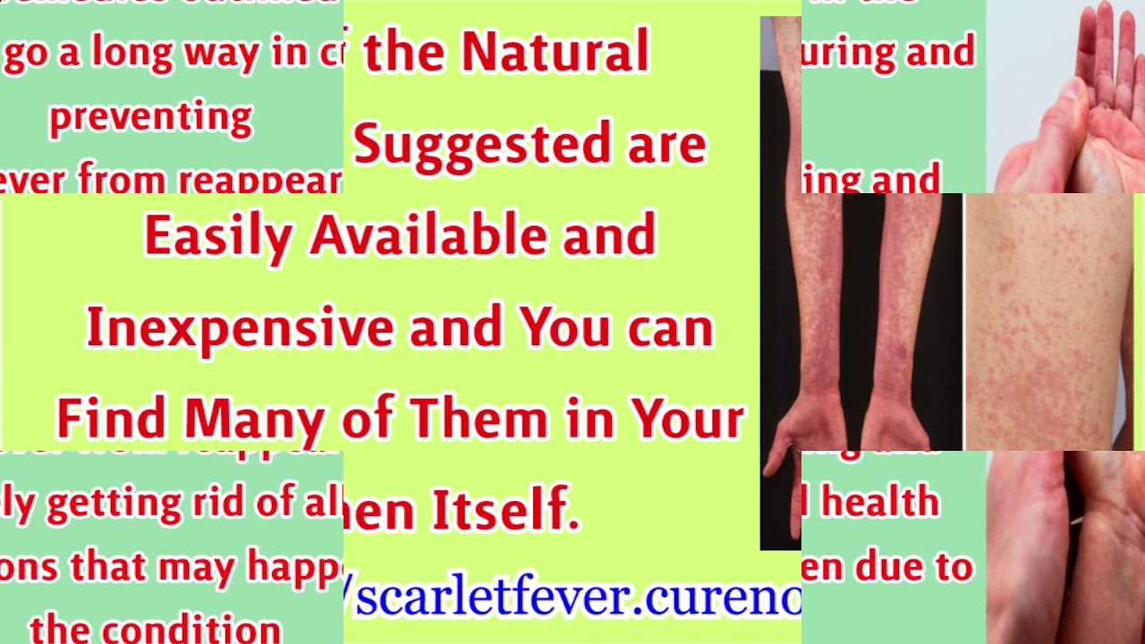 Treating Scarlet Fever & Pain Relief Natural Methods - YouTube