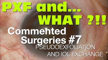 COMMENTED SURGERIES #7 - PXF and IOL exchange