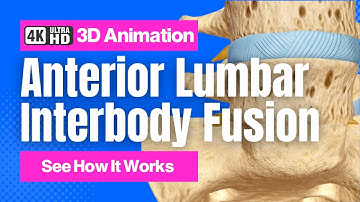 Anterior Lumbar Interbody Fusion (ALIF) - See How It Works - 3D Animation