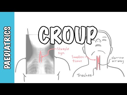 What is Croup (larynotracheobronchitis) - symptoms, pathophysiology, investigations, treatment