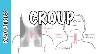 What is Croup (larynotracheobronchitis) - symptoms, pathophysiology, investigations, treatment