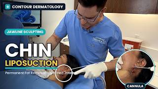 Liposuction Procedure | Dr. Jochen Walks Through the Full Surgical Process| Contour Dermatology