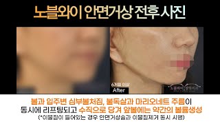 볼처짐+심부볼+불독살+마리오네트주름 동시에 리프팅시키는 김창연원장의 안면거상술(★더보기란 필독★)