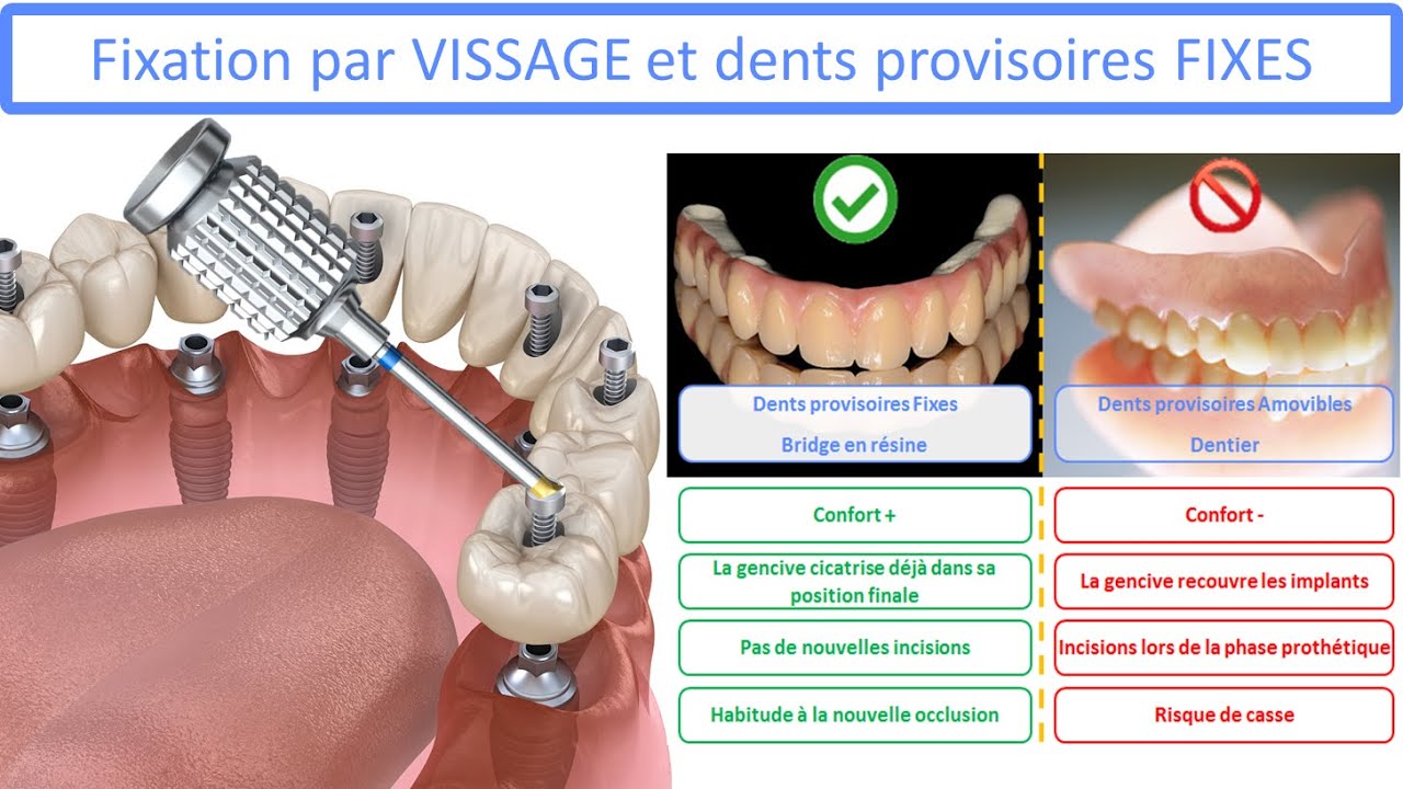 Charge immédiate sur implant dentaire - Des dents provisoires directement